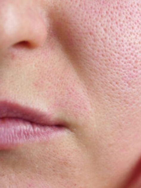 OPEN PORES