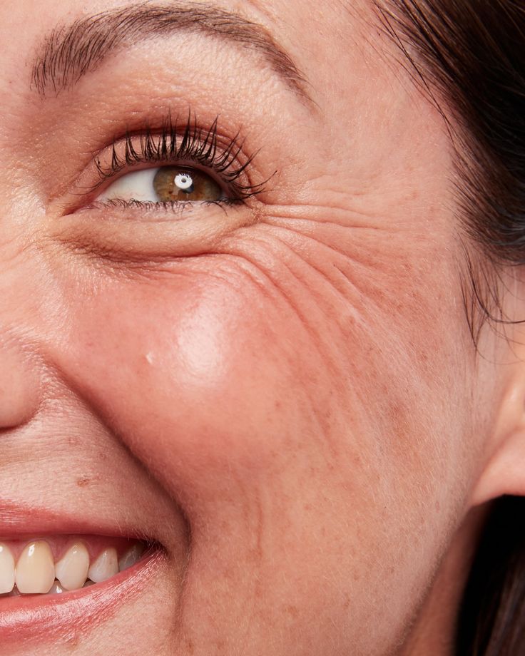 WRINKLES