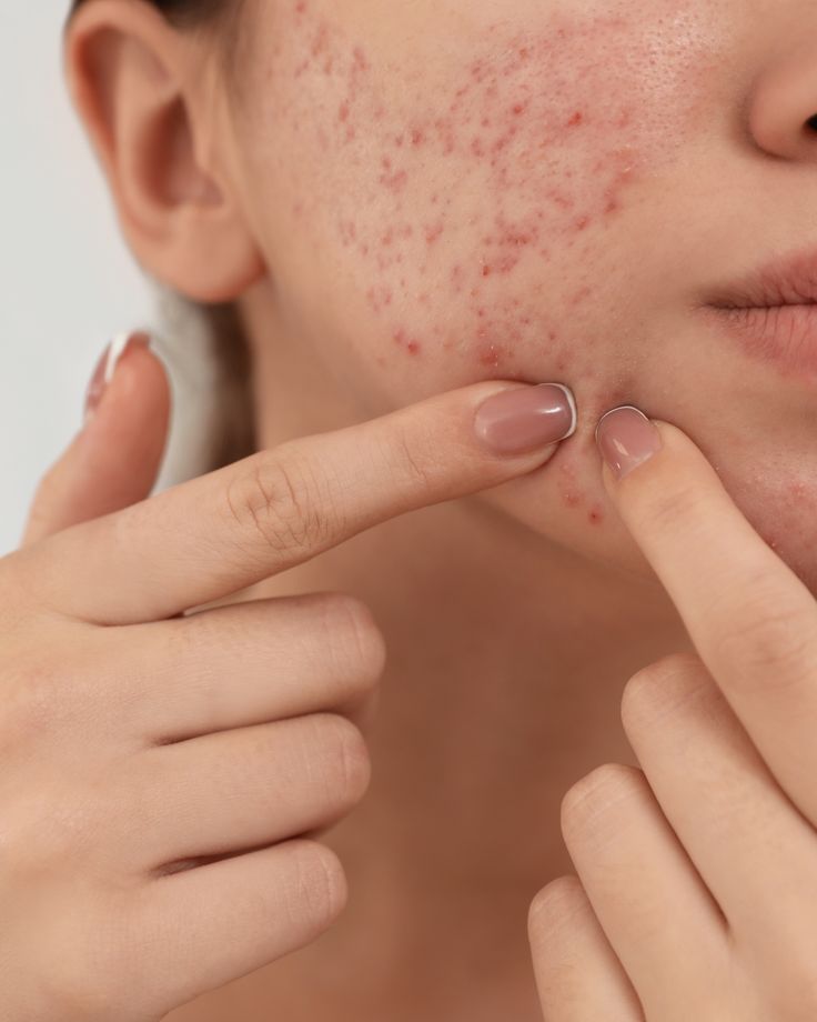 ACNE & BREAKOUTS