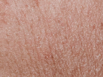 Dry Skin