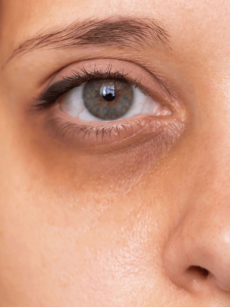 DARK CIRCLES