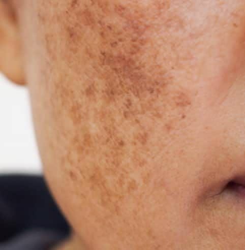 DARK SPOTS