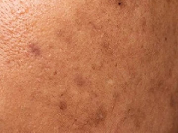 Pigmentation