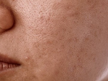 Uneven skin